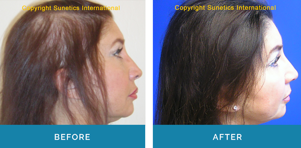 Hair Loss Treatment Before & After