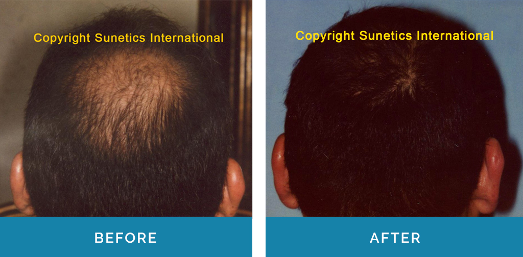 Hair Loss Treatment Before & After